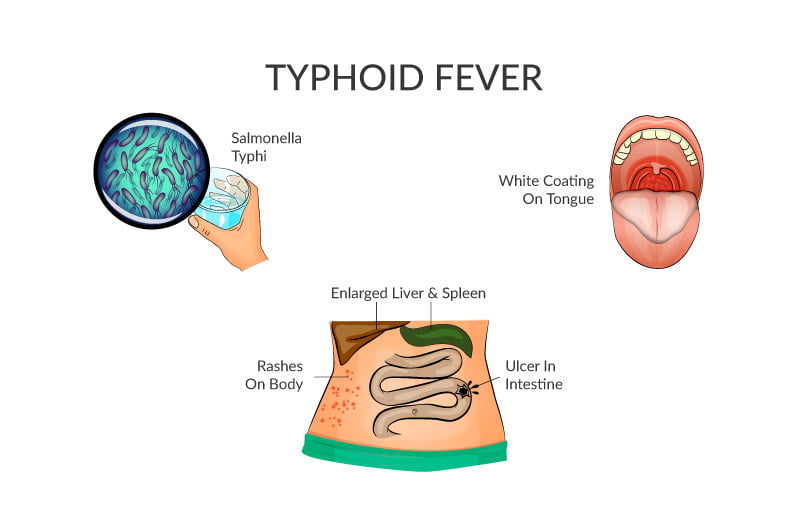 Typhoid Fever or Enteric Fever