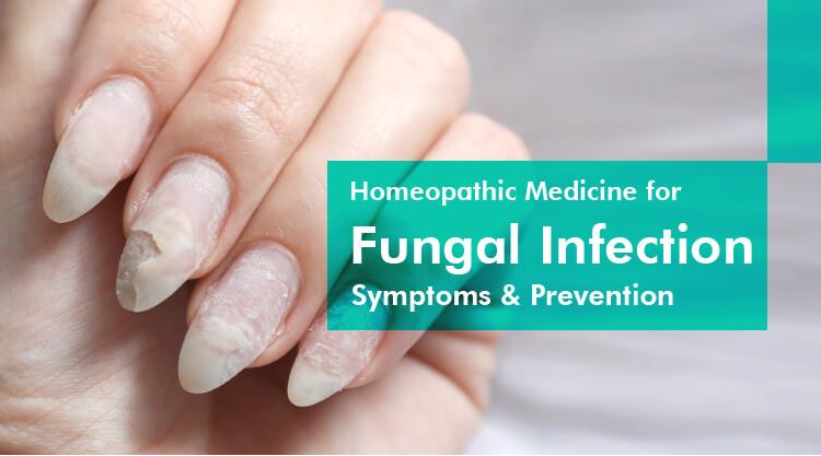 homeopathic-medicine-for-fungal-infection-symptoms-prevention