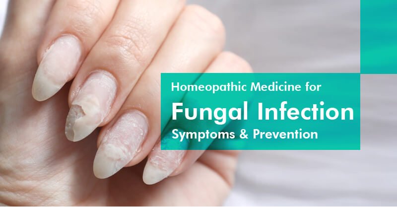 Fungal Nail Infection - How To Treat? - The Healthcare Hub - Cardiff
