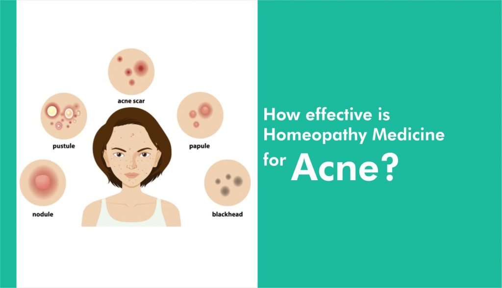 How Effective Is Homeopathy Medicine For Acne Homeoclinic 