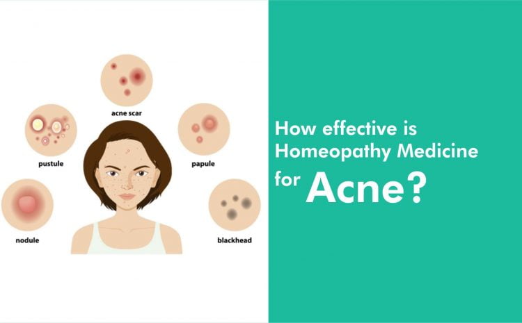  How effective is Homeopathy Medicine for Acne ?