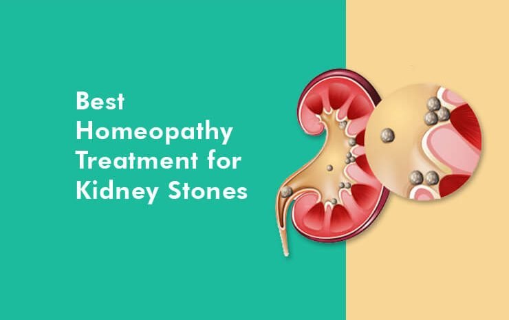  Best homeopathy treatment for kidney stones
