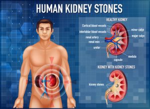 Treatment of kidney stones through homeopathy is reliable and safe