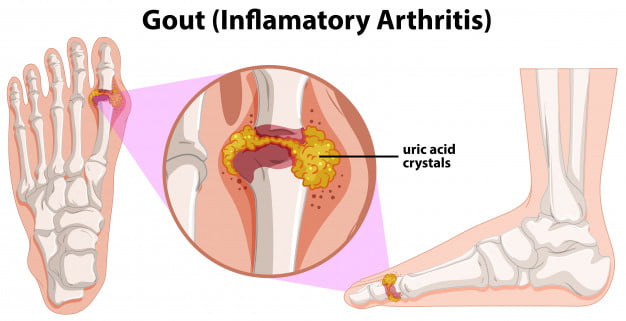 Gout (Inflammatory Arthritis)