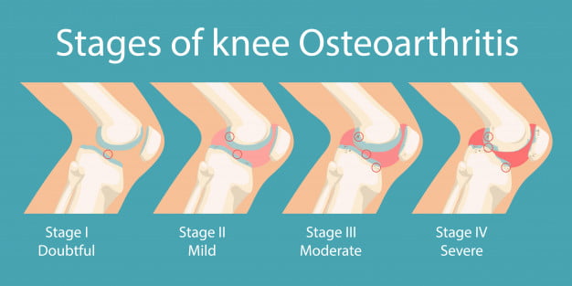 Stages osteoarthritis knee osteoarthritis human
