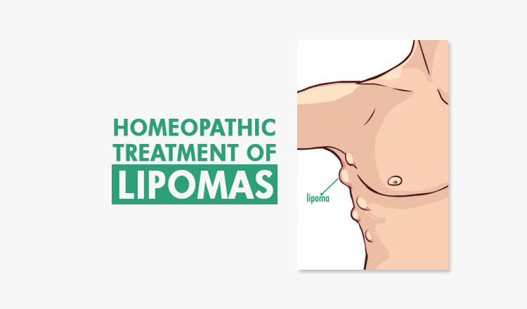  Homeopathic treatment for Lipomas – Amazing Guide