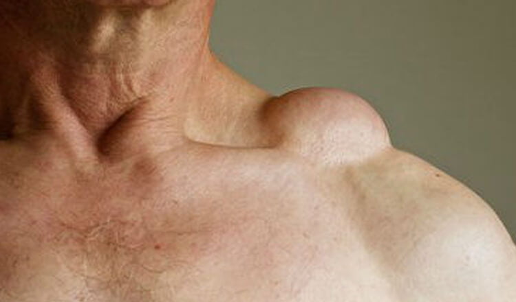 movable lump in neck