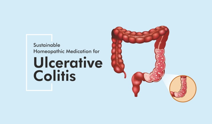  Sustainable Homeopathic Medication for Ulcerative Colitis