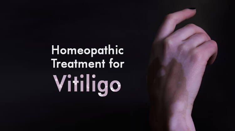  Homeopathic Treatment for Vitiligo