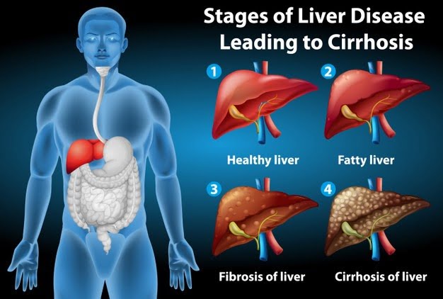 Stages of liver disease leading to Cirrhosis