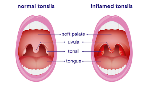 Tonsillitis