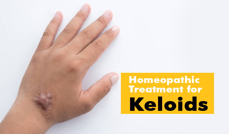  Homeopathic Treatment for Keloids