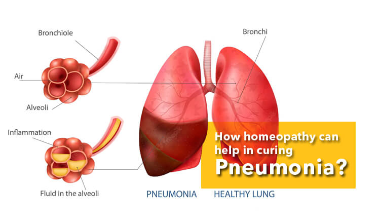  How homeopathy can help in curing pneumonia?