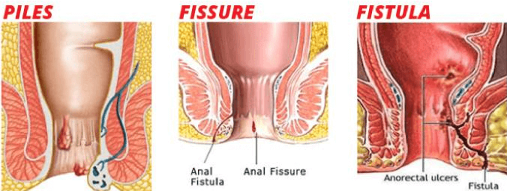 diagnose fistula and fissure
