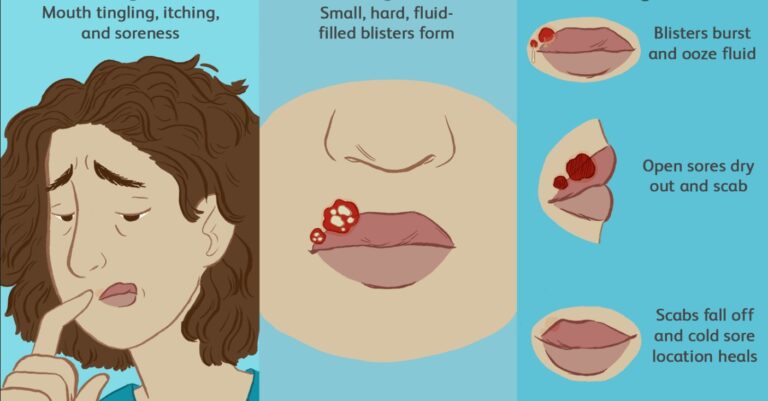 Cold Sores - Herpes Labialis - Homeopathy Medicines