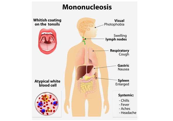 homeopathic-medicine-glandular-fever-called-infectious-mononucleosis