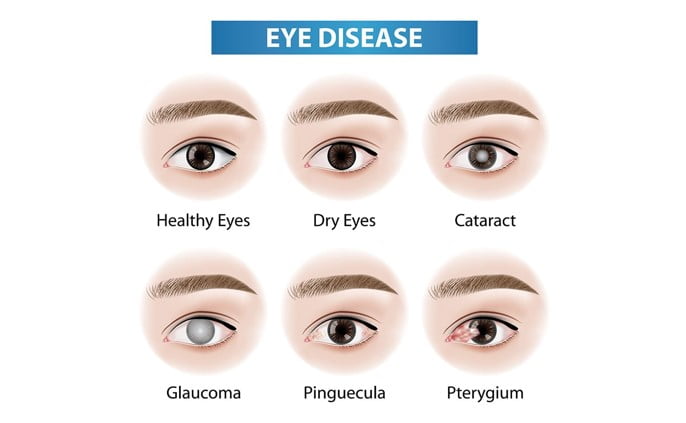 Common Eye Problems