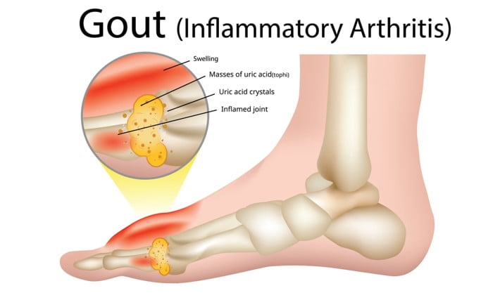  Homeopathy Medicines for Gout (Inflammatory Arthritis)