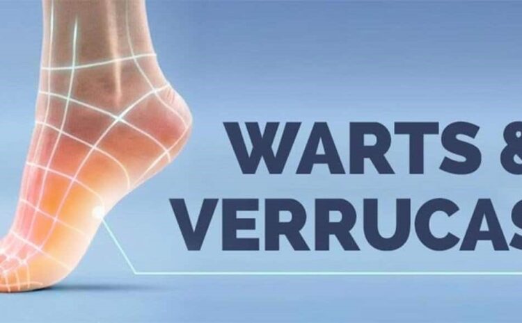  5 Best Homeopathic Medicine for Warts and Verrucas