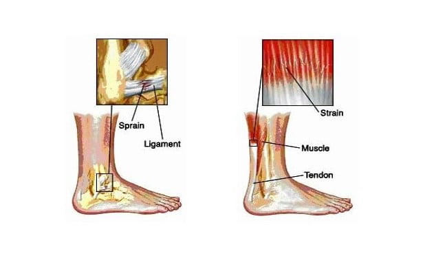 6 Best Homeopathic Medicines for Sprains and Strains.