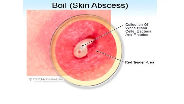 Abscesses and boils – 7 best homeopathic medicines