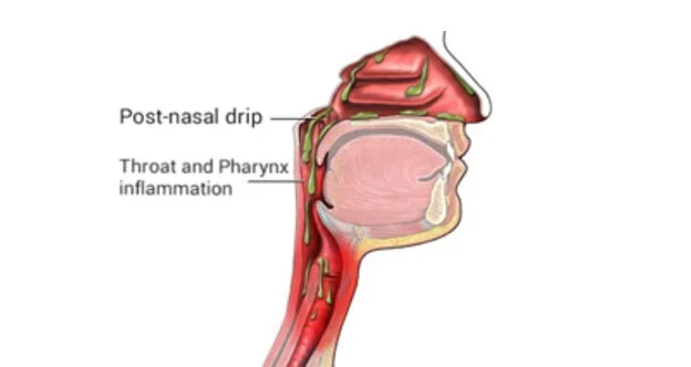 Catarrhal and Sinus Problems – 12 Best Homeopathic Medicines