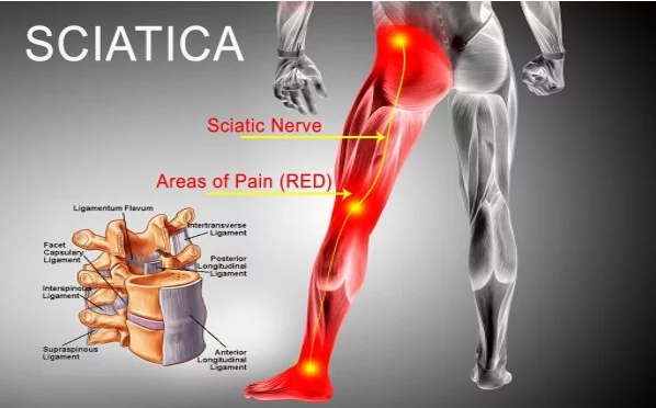 Sciatica – 9 best homeopathic medicines